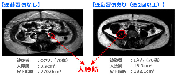 大腰筋のCTスキャン